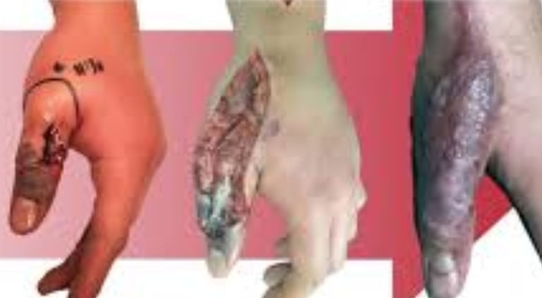 Necrotizing fasciitis Flesh-eating  