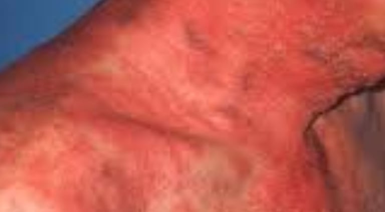   Herpes Zoster 