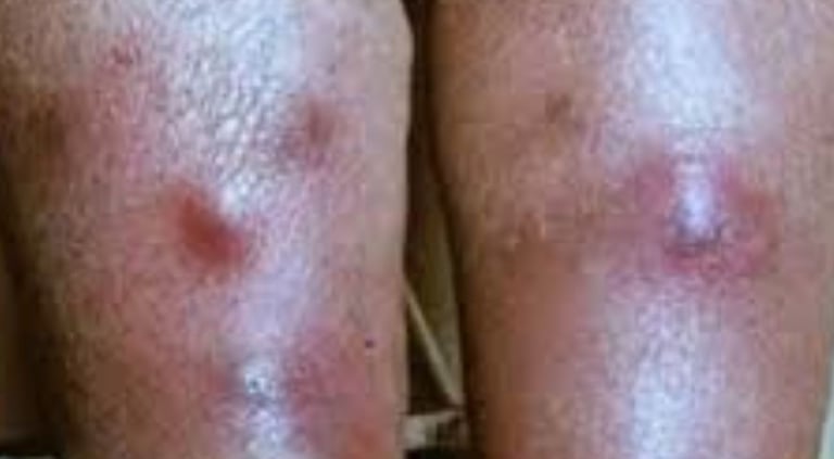 طفح جلدي أو ندوب حمراء، وقد تترافق مع حكة أو ألم