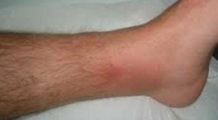 احمرار الساق