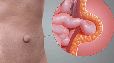 Imagem ilustrativa Hérnia Umbilical