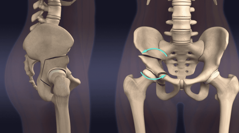 Osteotomia de Ganz, Berna, ou PAO.