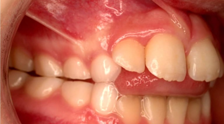a image showing tongue thrusting between incisors