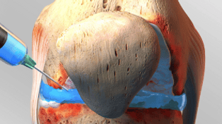 Dr.Rajinikanth's ortho clinic intra articular steroid