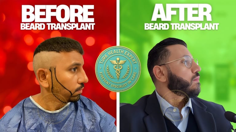 foto de y despues de trasplante de barba