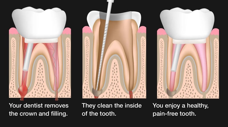 Root Canal Procedure Image