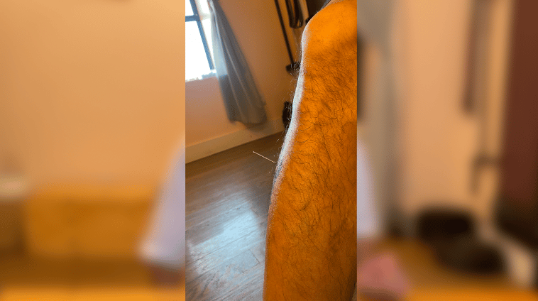 a pic showing an acupuncture needle in the shin muscle of the author, point name Stomach 36