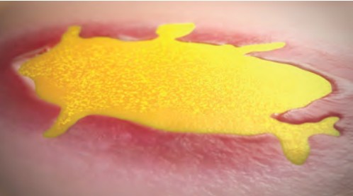 Omeza™ covering a chronic wound