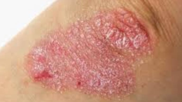🧬 How Fasting Calms the Immune System in Psoriasis and Eczema