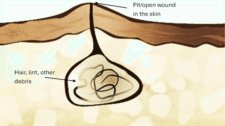 Diagram of a pilonidal cyst showing a skin pit and debris trapped in a subcutaneous cavity.