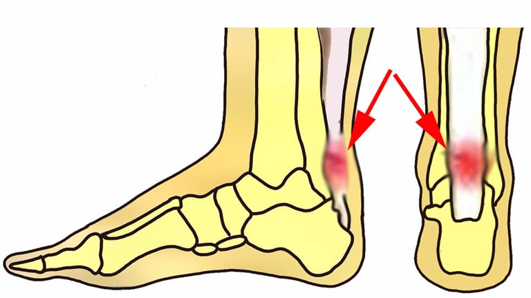 image of achilles tendinitis