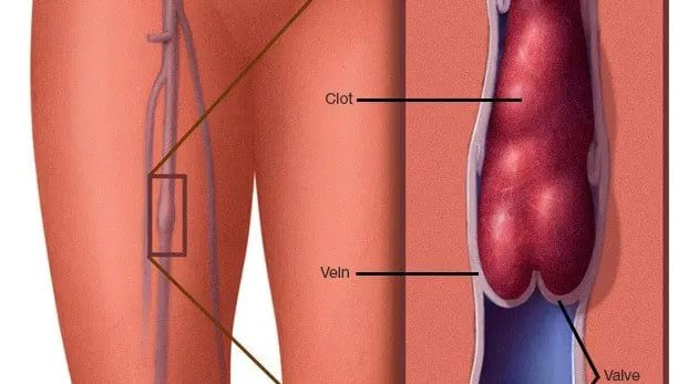 Venous thrombosis DVT Amman Jordan