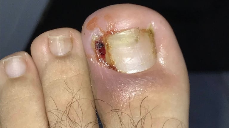 tratamiento uña encarnada Podocenter