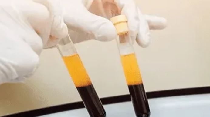 Tubos con plasma rico en plaquetas (PRP) utilizados en tratamientos de regeneración cutánea en AR Cl