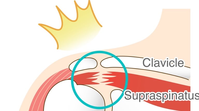 anatomic image of a torn rotator cuff muscle highlighted to indicate pain