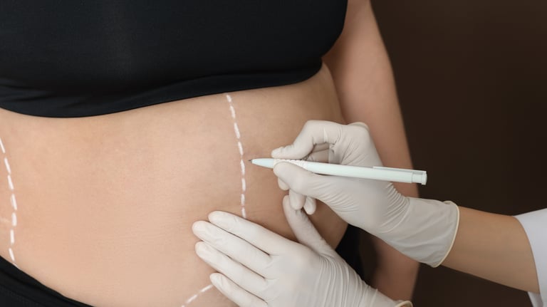 Dra. Lilyan Marissel - Cirugía Plástica y Estética - lipoabdoiminoplastia - contorno-corporal