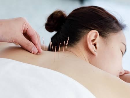 dry needling therapy for cervical pain to release trigger points.