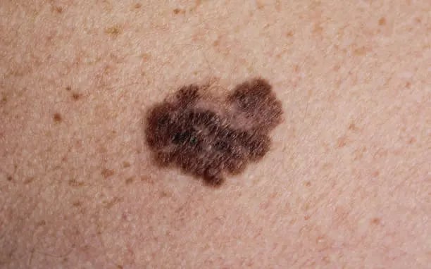 a close up of a person's skin cancerous skin cancerous skin cancer