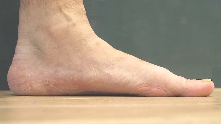 image of flat foot
