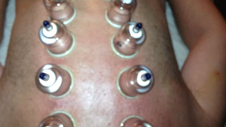 Cupping on back