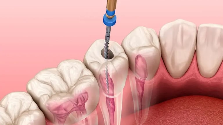 Instrumentação canal