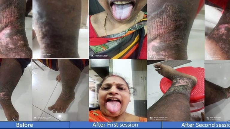 gangrene treatment without surgery Best chiropractor in Hyderabad