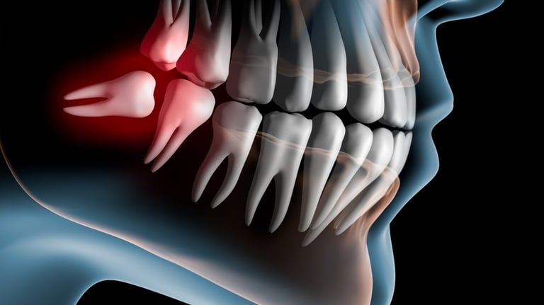 Picture showing impacted wisdom teeth