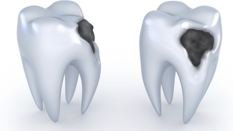Illustration médicale 3D : molaires humaines avec carie et cavités sombres.