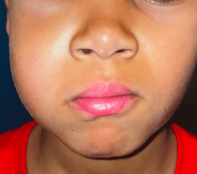 Gros plan : gonflement de la joue droite chez un enfant (oreillons ou infection).