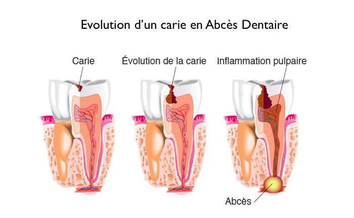 Évolution de la carie : de la cavité à l'abcès avec inflammation de la pulpe.