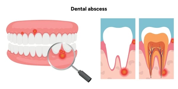 Schéma d'abcès : inflammation de la gencive et infection de la racine.