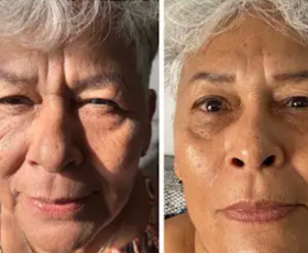 Awoman with a before and after photo after using a Riman skin care product