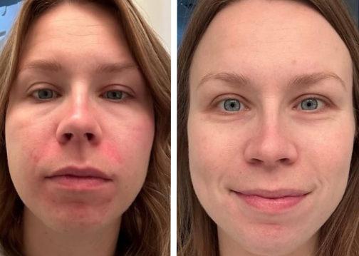 Awoman with a before and after photo after using a Riman skin care product