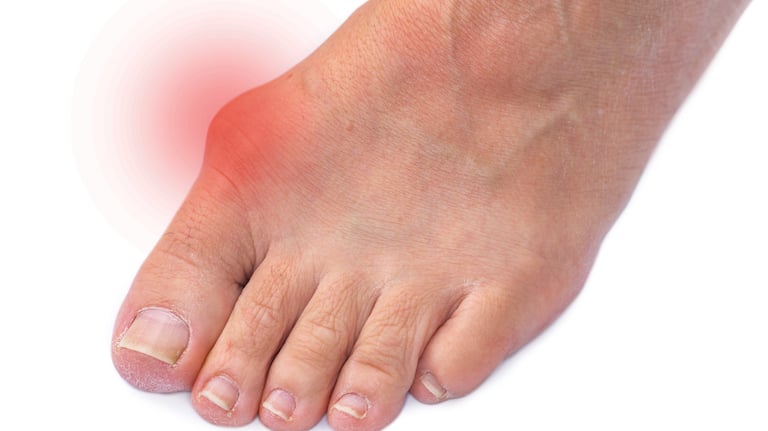 Close-up of a bunion with redness indicating an inflamed big toe joint.