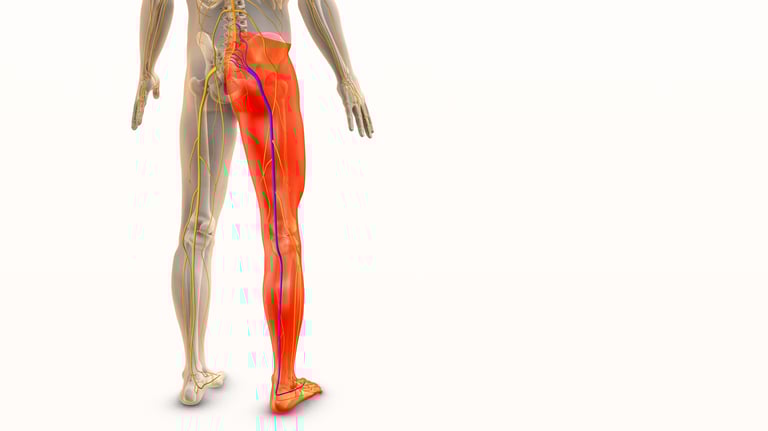 Anatomy of lower body showing sciatic nerve pain running from lower back and glute/pelvis to leg