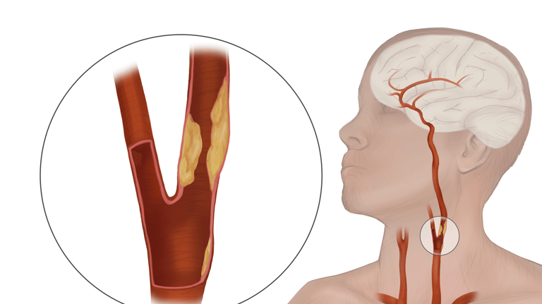 Carotid artery stenosis- Dr. Omar Hamdallah