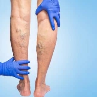 Varicose Veins treatment in Amman Jordan
