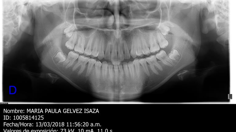 exodoncia de cordales cerca de mi