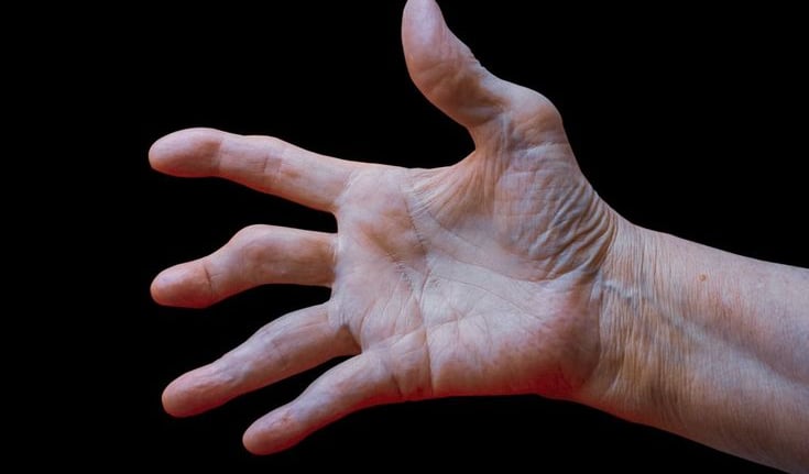 Alivio del dolor articular por artrosis con fisioterapia en Toledo