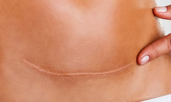 osteopatia per il trattamento delle cicatrici