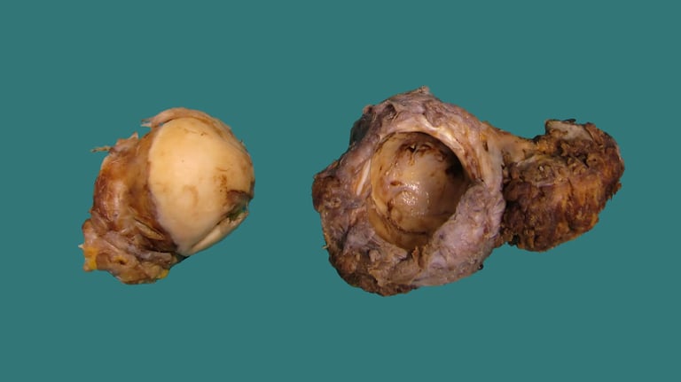 anatomía patológica hueso