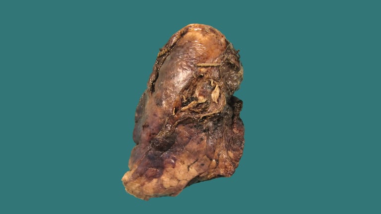 anatomía patológica tórax y mediastino