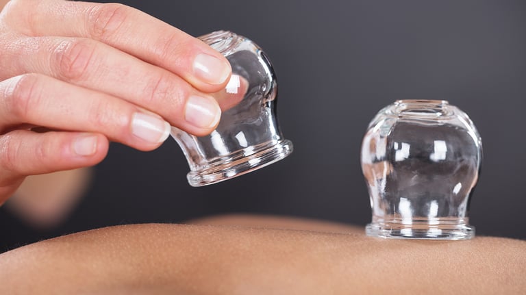 Acupuncture cups being placed on a person's back during treatment.