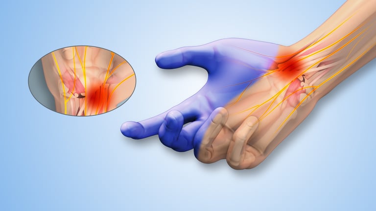 Anatomic image of inflamed wrist and carpal tunnel showing carpal tunnel syndrome nerve pain. 