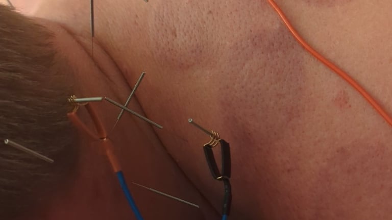 Electroacupuncture treatment on a patient's back with needles, wires, and cupping marks for pain relief.