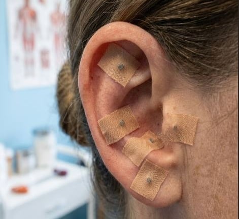 A close-up of a patient's ear with auricular acupuncture seeds applied using adhesive tape for holistic therapy.