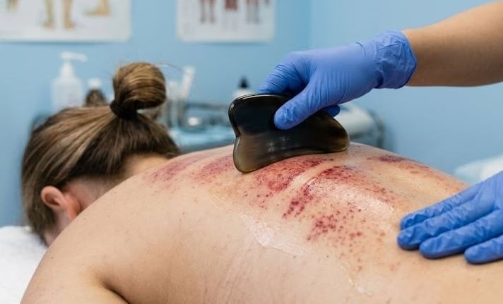 Gua Sha scraping therapy showing prominent red sha petechiae on a prone client's back