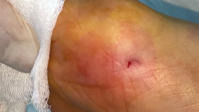 cirugia mini incision juantes, dedos en garra, espolón calcando, dolor del pie