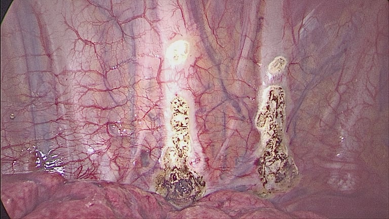 Sympathectomy for excessive sweating in Malta