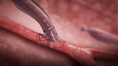 haemodialysis disease artery vein arteriovenous fistula diabetes kidney failure renal bruit avf dialysis vascular ultrasound